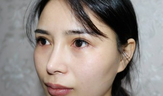 眼袋怎么去掉（遗传的眼袋怎么去掉）