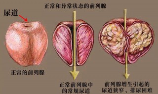 前列腺增生伴钙化是什么意思（前列腺增生伴钙化是什么意思,严重不）