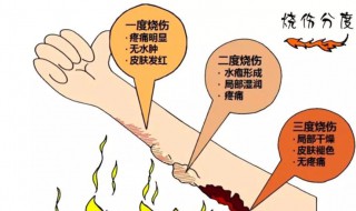 烧伤怎么处理好的快 烧伤怎么弄好的快