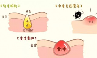 怎样处理青春痘（怎样处理青春痘?）