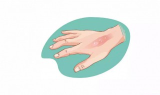 手被油烫伤起泡怎么处理 手被油烫起泡了怎么处理