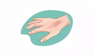 烫伤破皮后怎么处理 烫伤破皮了该怎么办