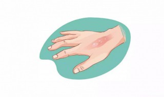 烟头烫伤后怎么处理 烟头烫伤怎么办?