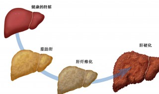 脂肪肝是啥意思 脂肪肝怎么调理最好最快