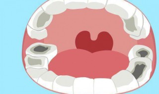 蛀牙如何让它停止腐蚀（蛀牙如何让它停止腐蚀,不补牙）
