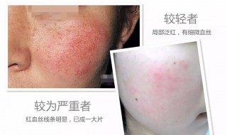 红血丝怎样去除 红血丝怎样去除是最好的