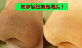 清理黑头最有效的方法 清理黑头一次就能看出效果的方法