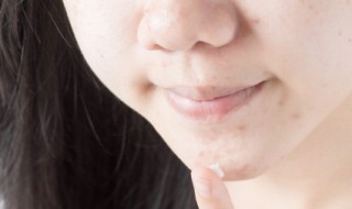 怎样去痘印最快最有效 怎样祛痘印最快最有效的方法学生