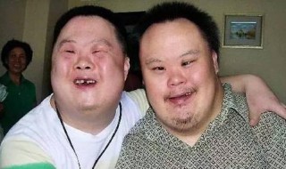 唐氏综合征的面貌 唐氏综合征的面貌图片