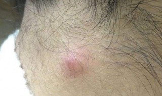 疖子怎么排脓效果好 疖子脓怎么样排干净