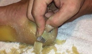 脚掌长茧预示的疾病 脚掌长茧是怎么回事
