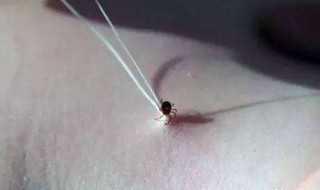 被虫子咬了怎么消肿（被虫子咬了怎么消肿止痛）