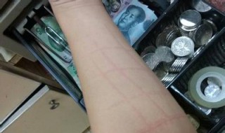 寻麻的症状和治疗方法 寻麻怎么治疗好得快